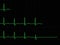 ECG set