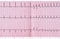 ECG with supraventricular extrasystole and short paroxysm of atrial fibrillation