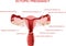 Ectopic Pregnancy concept. Infographics. illustration on isolated background.