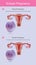 Ectopic pregnancy. Infographic Illustration.