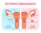 Ectopic Pregnancy or Tubal pregnancy medical diagram with female reproductive system and various embryo attachment locations.
