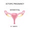 Ectopic Pregnancy. Types of extra-uterine pregnancy is interstitial