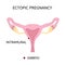 Ectopic Pregnancy. Types extra-uterine pregnancy. Intramural