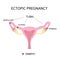 Ectopic Pregnancy. Types of Tubal pregnancy, ovarian, fimbrial