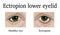 Ectropion of the lower eyelid