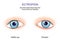 Ectropion. the lower eyelid droops away from the eye and turns outwards