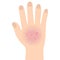 Eczema affected a hand Dermatology skin disease concept