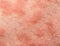 Eczema atopic dermatitis