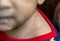 Eczema can show up as red, crusty patches on your baby`s skin, often during their first few months. Itâ€™s common and very