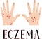 Eczema. Diseased skin. Sore hands. Medical poster