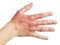 Eczema on a female hand