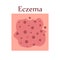 Eczema on human skin with itching, pain and rash