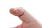 Eczema on Male Thumb