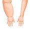 Edema, swollen hand or arm, lymphedema disease