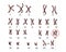 Edwards-syndrome karyotype