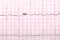 EKG printout