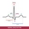 EKG showing normal heartbeat wave. ECG of Normal Sinus Rhythm infographic diagram