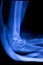 Elbow arm orthopedic implant xray scan