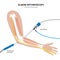 Elbow arthroscopy surgery