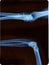 Elbow radiography