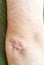 Elbow Skin Psoriasis disease Problem