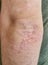 Elbow Skin Psoriasis disease Problem