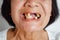 The elderly Asian woman smiled and saw the teeth remaining in the mouth.