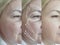 Elderly result arrow  woman removal wrinkles result regeneration hydrating mature before and after treatment