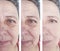 Elderly woman face wrinkles before and after cosmetology procedures