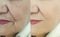 Elderly woman wrinkles before after collagen biorevitalization rejuvenation correction cosmetology regeneration treatment