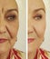 Elderly woman wrinkles before after collagen mature biorevitalization rejuvenation correction cosmetology regeneration treatment