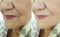 Elderly woman wrinkles  before after collagen  rejuvenation correction cosmetology regeneration treatment