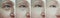 Elderly woman wrinkles eyes regeneration blepharoplasty before and after treatment