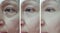 Elderly woman wrinkles eyes regeneration blepharoplasty before and after treatment