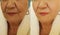 Elderly woman wrinkles face before after correction cosmetology regeneration treatment