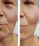 Elderly woman wrinkles on face medical before after