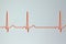 Electrocardiogram ECG displaying sinus arrhythmia, 3D illustration