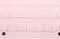 Electrocardiogram graph report