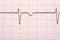 Electrocardiogram Printout