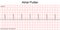 Electrocardiogram show Atrial flutter pattern.