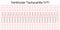 Electrocardiogram show monomorphic ventricular tachycardia VT.