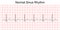 Electrocardiogram show normal heart beat line Sinus rhythm.