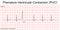 Electrocardiogram show Premature Ventricular Contraction PVC pattern.