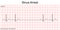 Electrocardiogram show Sinus arrest pattern.