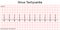 Electrocardiogram show Sinus tachycardia pattern.