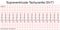 Electrocardiogram show Supraventricular tachycardia SVT pattern.