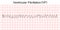 Electrocardiogram show ventricular fibrillation VF pattern.