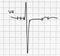 Electrocardiogram test that shows electrical activity of the heart
