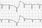 Electrocardiogram test that shows electrical activity of the heart