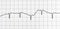 Electrocardiogram test that shows electrical activity of the heart